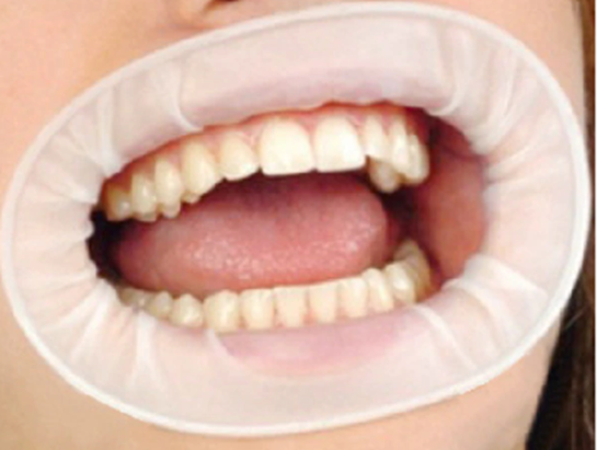 dentamedix-o-style-latex-cheek-retractor-60-box-white-medium-87x87mm